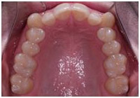 invisalign example