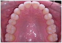 clear braces example