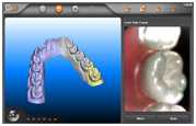 3D Dental Scanner